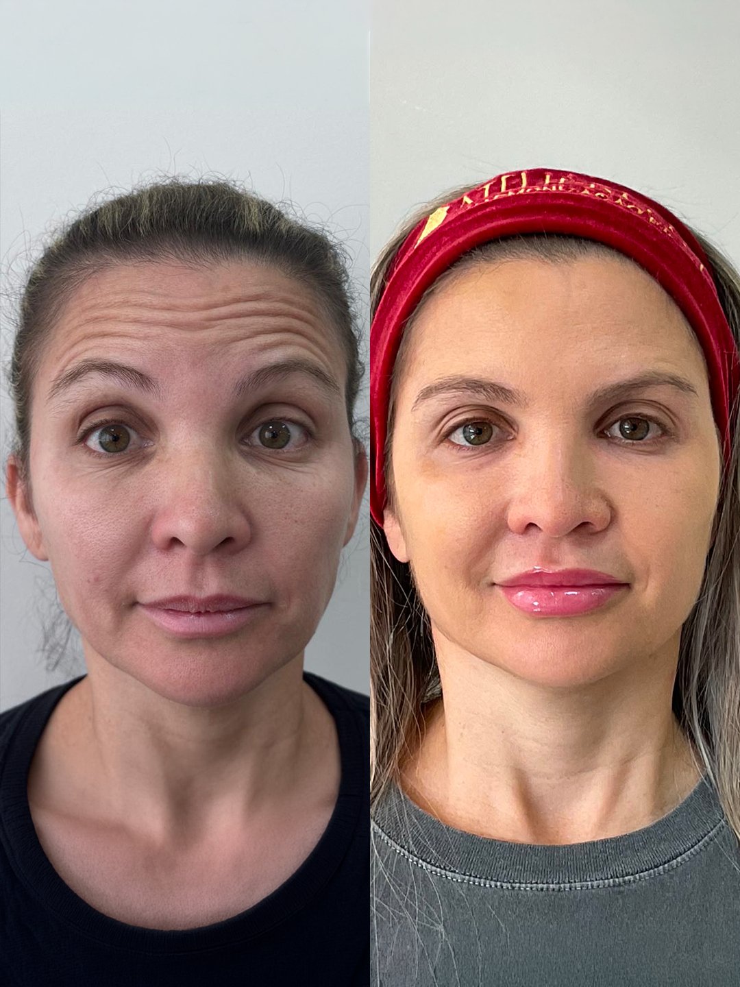 Comparativo de antes e depois para linhas de expressão