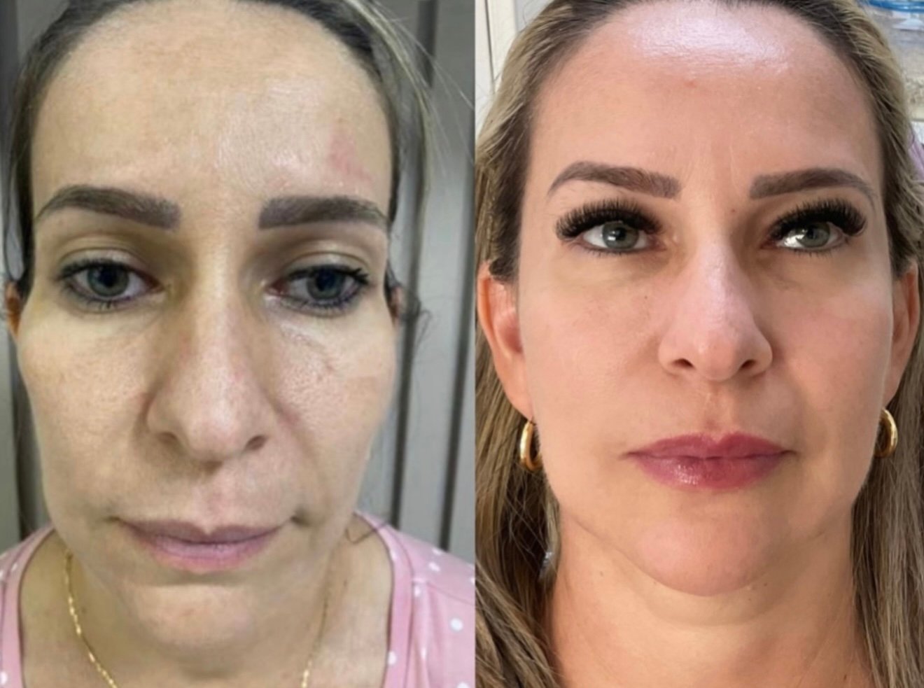 Comparativo de antes e depois para flacidez facial